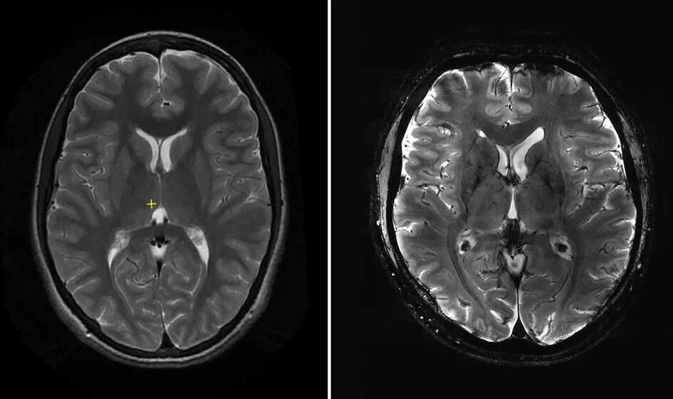 Снимки мрт головного мозга норма. Снимок мрт головного мозга в норме. Мрт снимки мозга норма. Мрт ГМ норма.