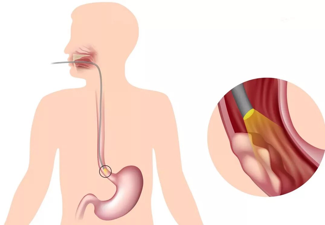 Пищевод жжение лечение. Полип пищевода эзофагоскопия.