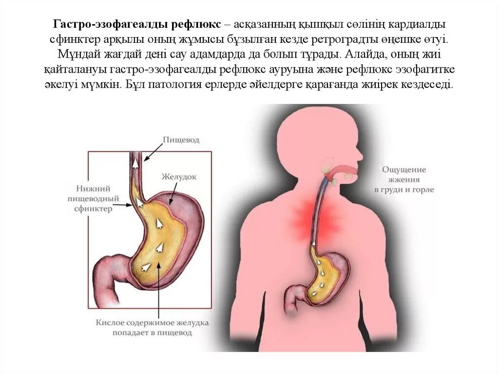 Препараты при рефлюксе желудка. Сфинктер между желудком и пищеводом. Сфинктер желудка и пищевода.