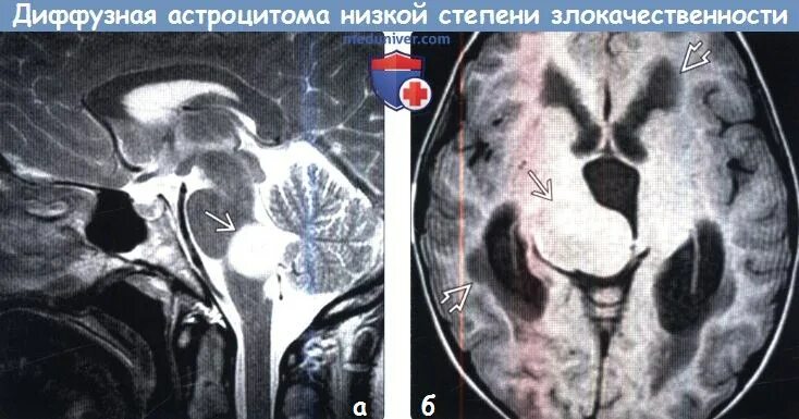 Астроцитома 4 желудочка. Диффузная астроцитома кт. Диффузная астроцитома мрт. Астроцитома низкой степени злокачественности на мрт. Диффузная астроцитома