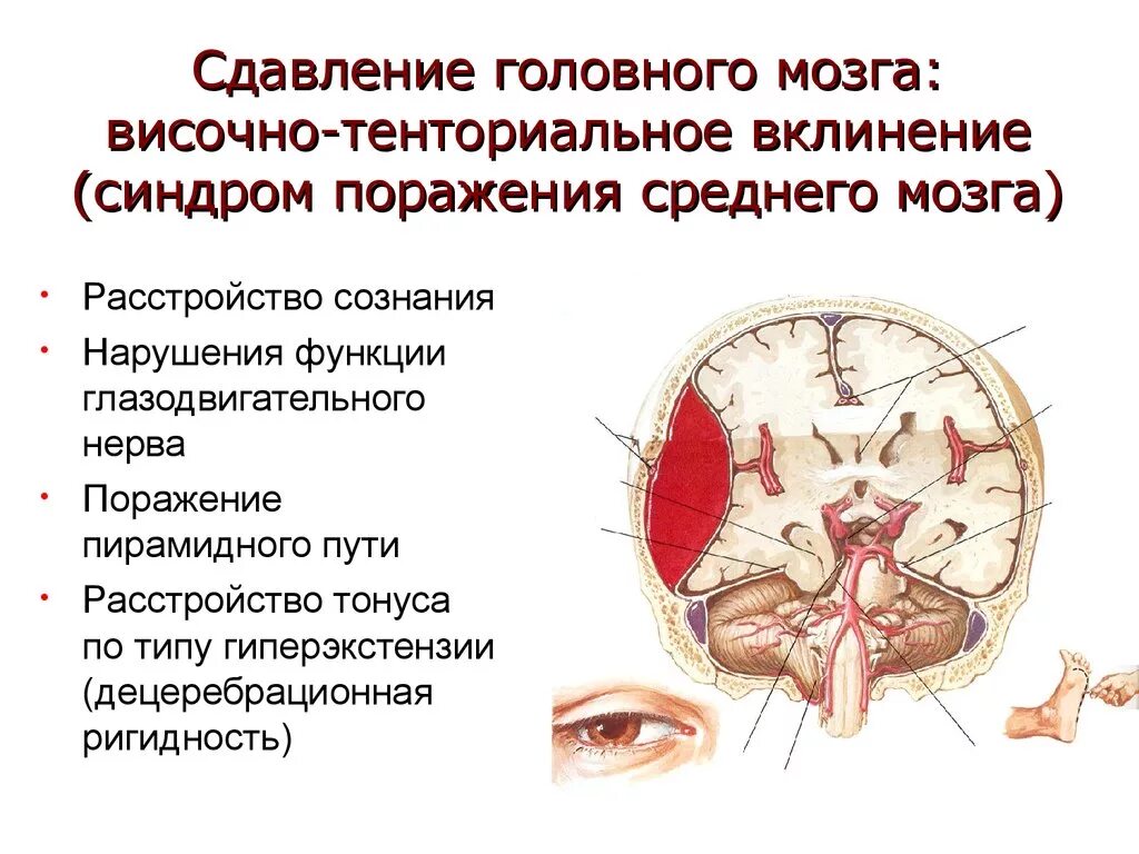 Клинический синдром поражения среднего мозга. Височно-тенториальное смещение. Вклинивание ствола мозга симптомы. Сдавливание ствола мозга.