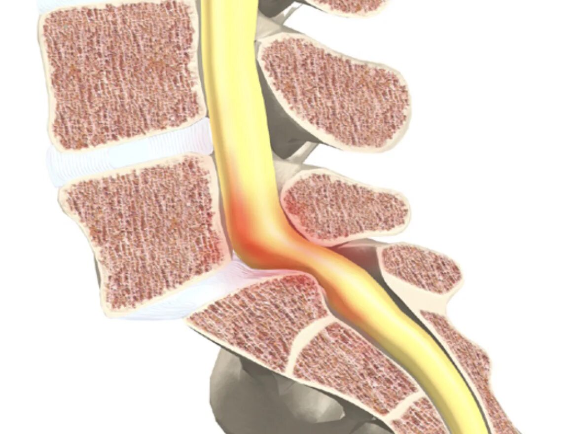 Спинальная нестабильность что это. Сдавление спинного мозга при остеохондрозе. Сдавление позвоночной артерии. Нестабильность сегмента позвоночника. Защемление сосудов в шейном отделе позвоночника.