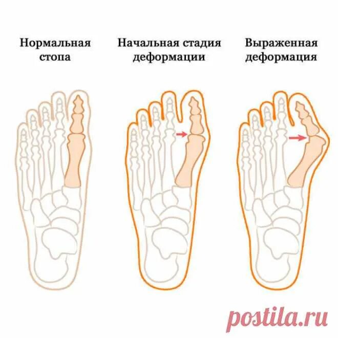 Как правильно вставлять пальцы. Вальгусная деформация стопы hallux valgus. Халлюкс вальгус степени. Правильное положение большого пальца стопы. Вальгус большого пальца на ноге.