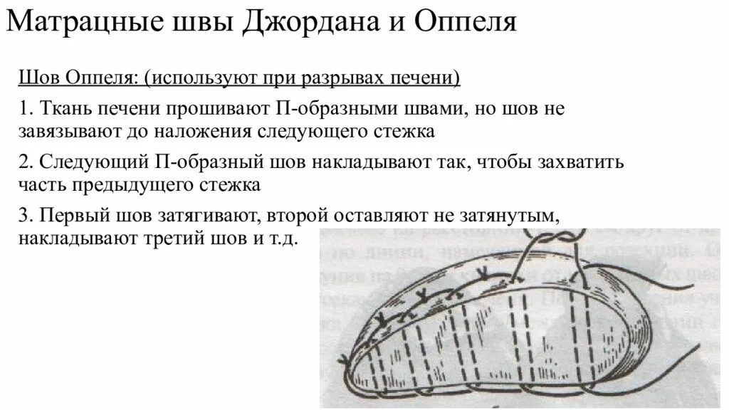 Шов паренхиматозных органов. Шов кузнецова-пенского на печени. гемостатический шов кузнецова-пенского. шов оппеля на печень. гемостатический шов печени.