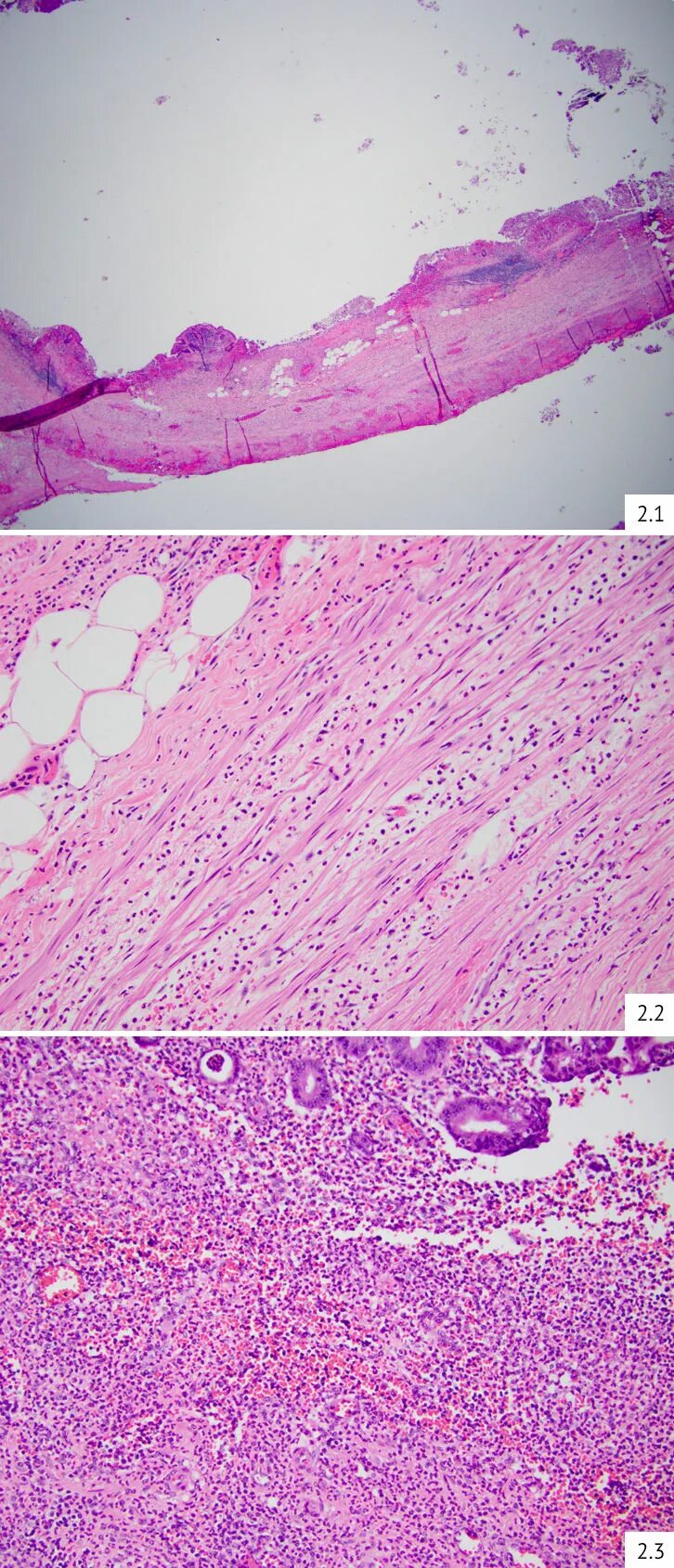 Флегмонозный Гнойный аппендицит. Флегмонозно язвенный аппендицит микропрепарат. Катаральный аппендицит гистология. Гнойный аппендицит гистология.