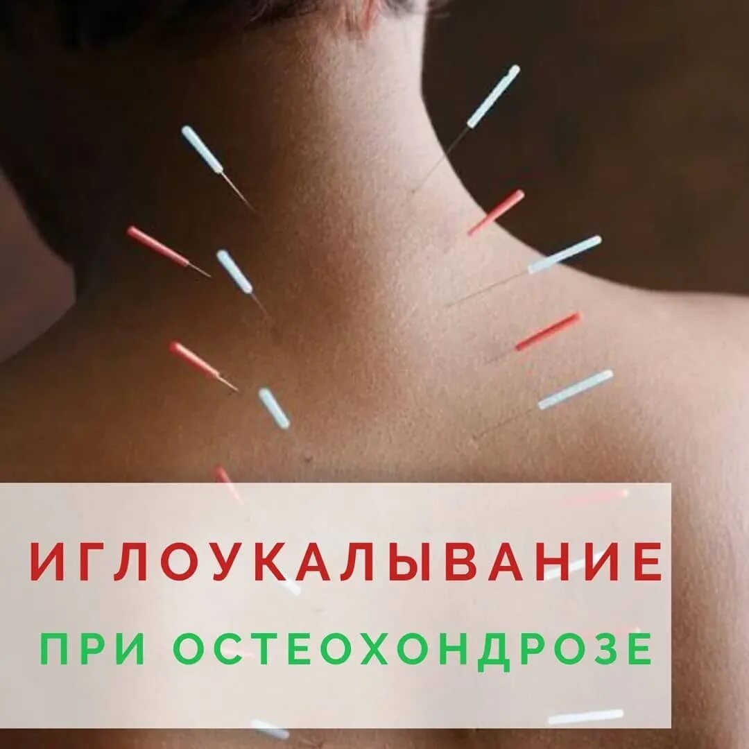 иглоукалывание при остеохондрозе. иглорефлексотерапия. иглотерапии при остеохондрозе шейного. безигольчатая рефлексотерапия. точки акупунктуры при остеохондрозе шейного отдела позвоночника.