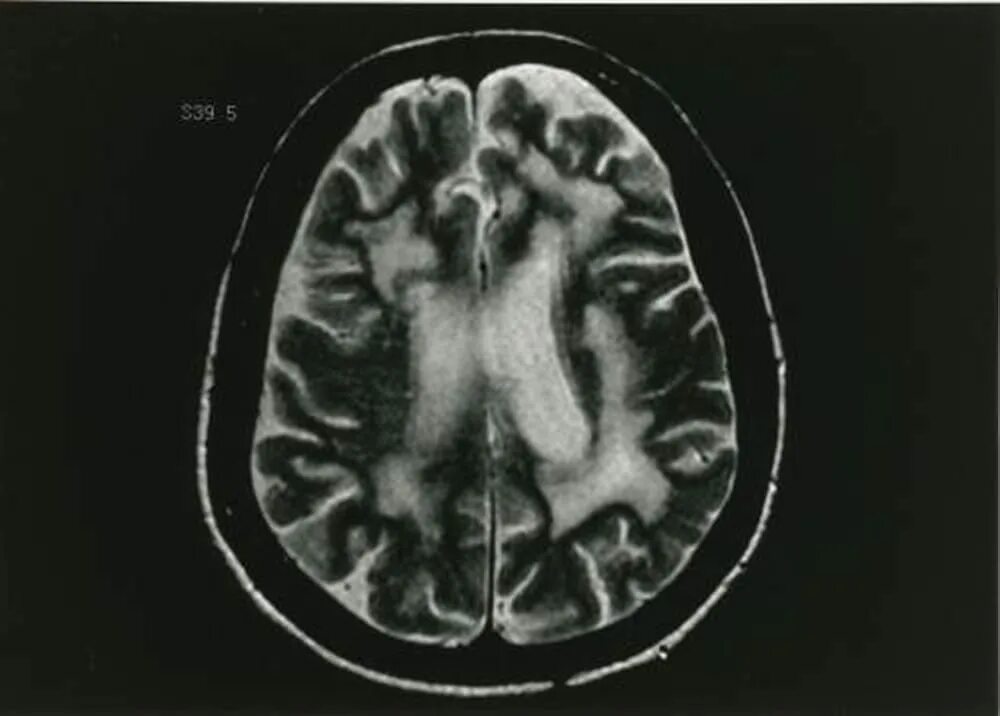 Многоочаговое поражение мозга. Мультифокальная лейкоэнцефалопатия мрт. ПМЛ мрт прогрессирующая мультифокальная лейкоэнцефалопатия. Лейкоэнцефалопатия головного мозга кт. Мультифокальная лейкоэнцефалопатия кт.