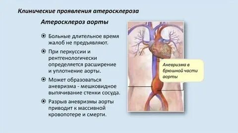 Атеросклероз аорты и ее ветвей что это. Атеросклероз аорты и ее ветвей что это