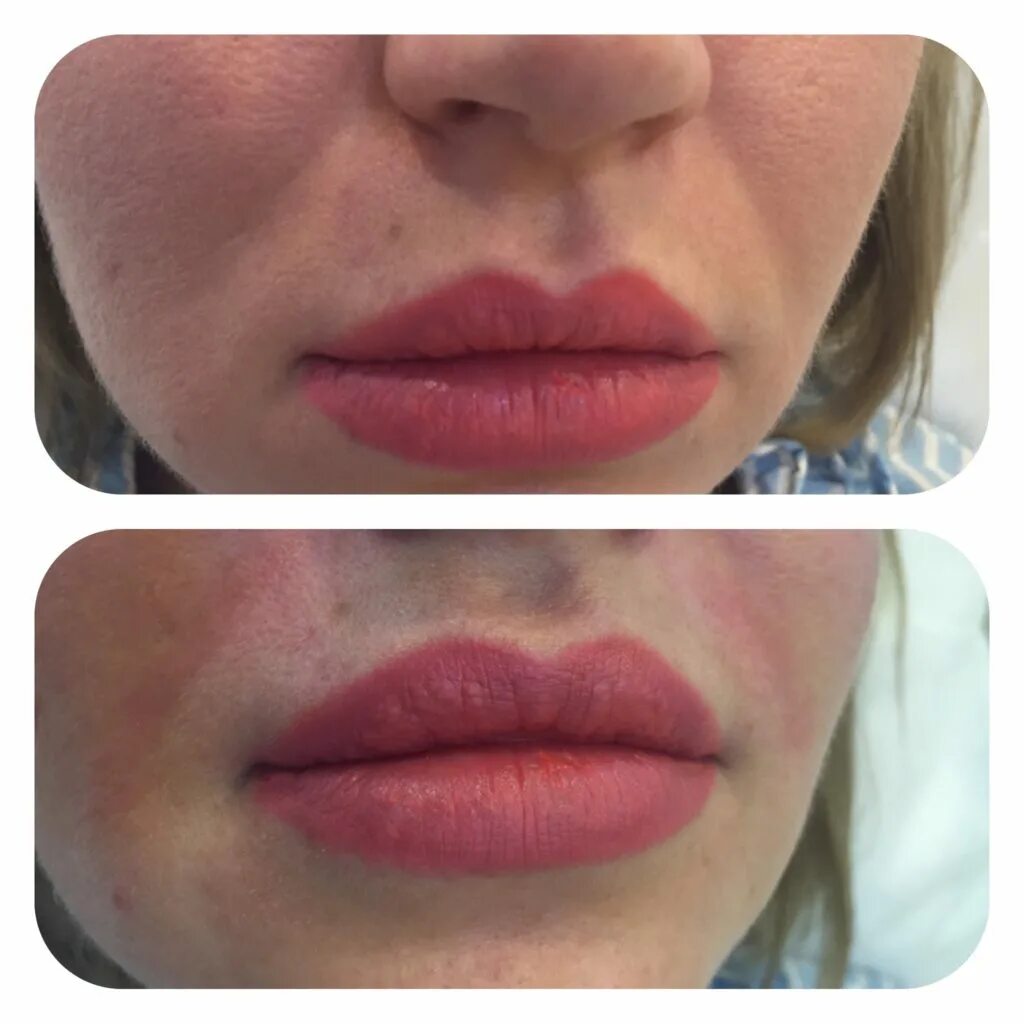 после увеличения губ появилась складка. аугментация губ и носогубных складок. отек после инъекции в носогубные. биополимерный гель в губах. контурная пластика губ и носогубных складок.