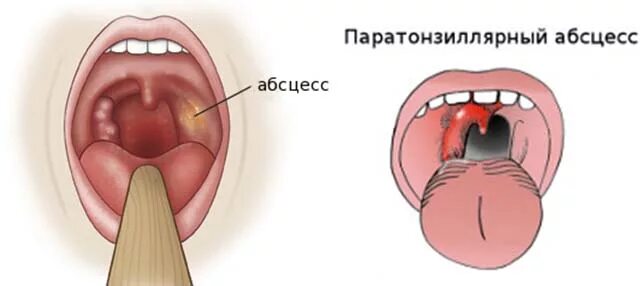 Асимметрия зева