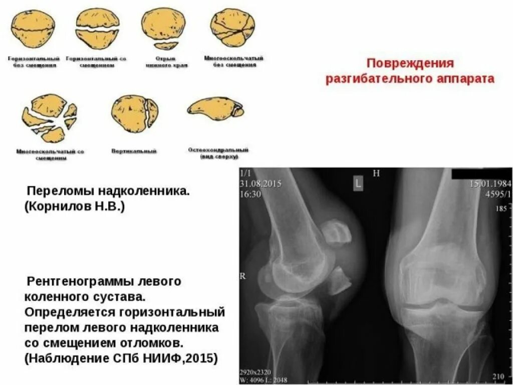 Травмы надколенника классификация. Надколенник коленного сустава перелом. Переломы надколенника классификация. Краевой перелом надколенника без смещения. Перелом надколенника операции