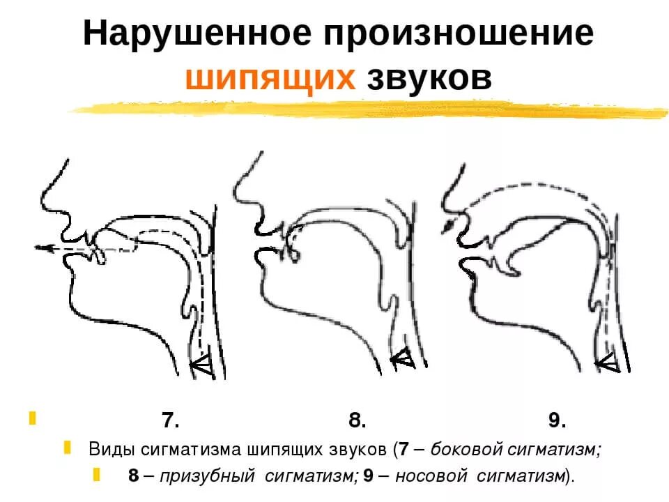 Нижняя артикуляция. Логопедические профили шипящих звуков. Нарушенное произношение шипящих звуков. Сигматизм боковой, носовой. Профиль артикуляции звука ш при боковом сигматизме.