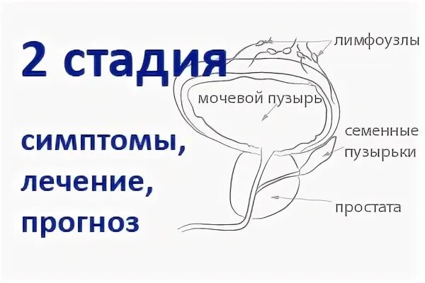 Стадии предстательной железы. Стадии ЗНО предстательной железы. Стадии онкологии предстательной железы. После удаления простаты форум