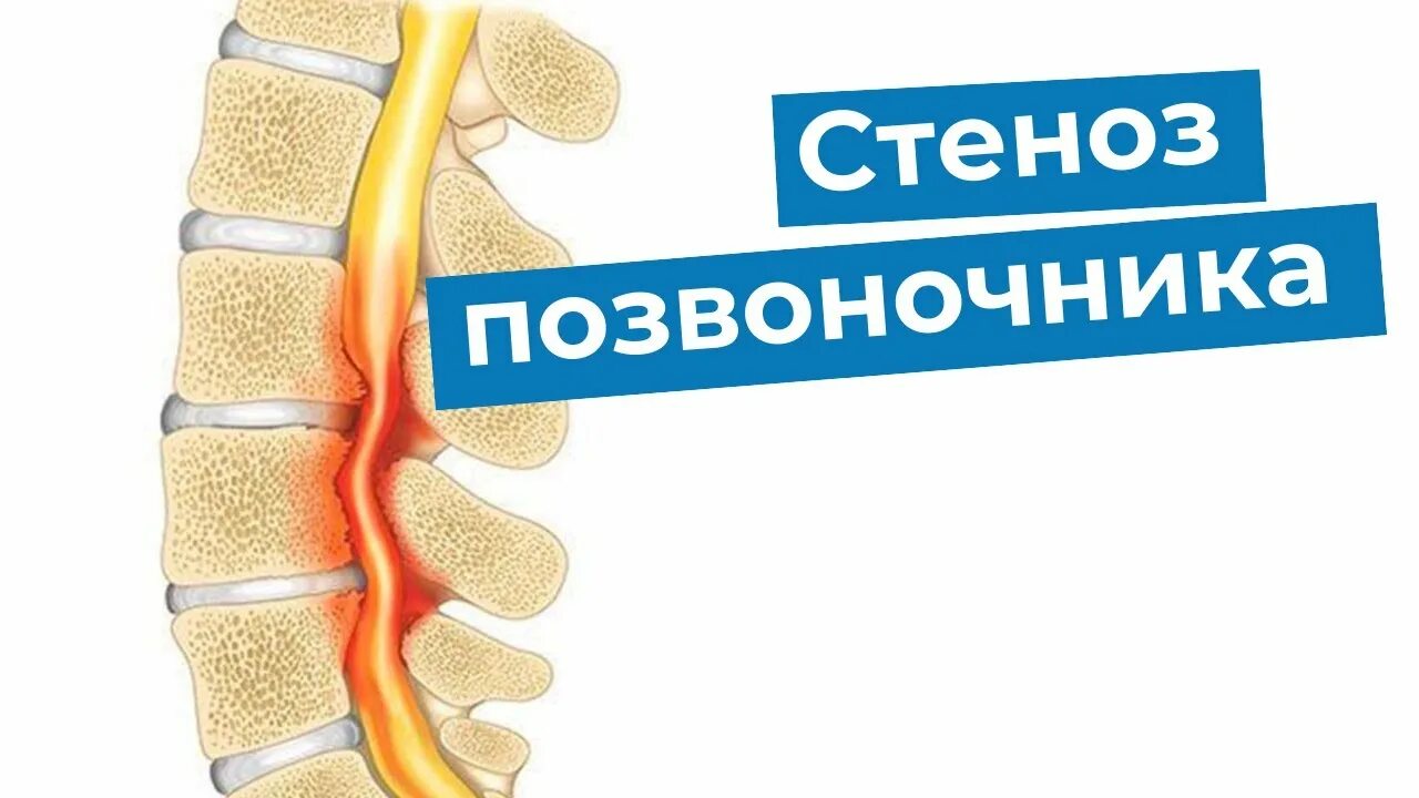 Стеноз позвоночника. Абсолютный стеноз позвоночного. Стеноз позвоночного канала. Абсолютный стеноз позвоночного канала.