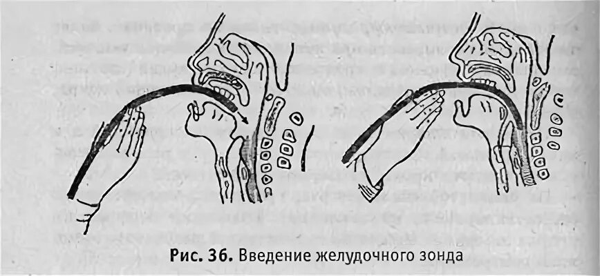 Форум зонд. Введение желудочного зонда. Введение желудочного зонда через рот. Введение желудочного зонда через рот алгоритм. Введение зонда в желудок алгоритм.