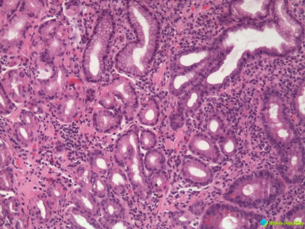 поверхностный гастрит хеликобактер. хеликобактер-индуцированный гастрит. язва желудка бактерия хеликобактер. поверхностный и атрофический гастрит. поверхностный гастрит хеликобактер.