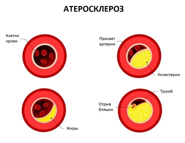 Какой холестерин при атеросклерозе. Холестерин в крови. высокий уровень холестерина. опасный уровень холестерина. показатель высокого холестерина в крови.