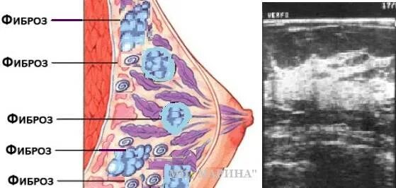 Признаки фиброзных изменений молочных. Фиброзно-кистозная мастопатия молочных желез гистология. Фиброзно-железистая ткань молочной железы. Фиброз мастопатия молочной железы. Фиброз ткани молочной железы.