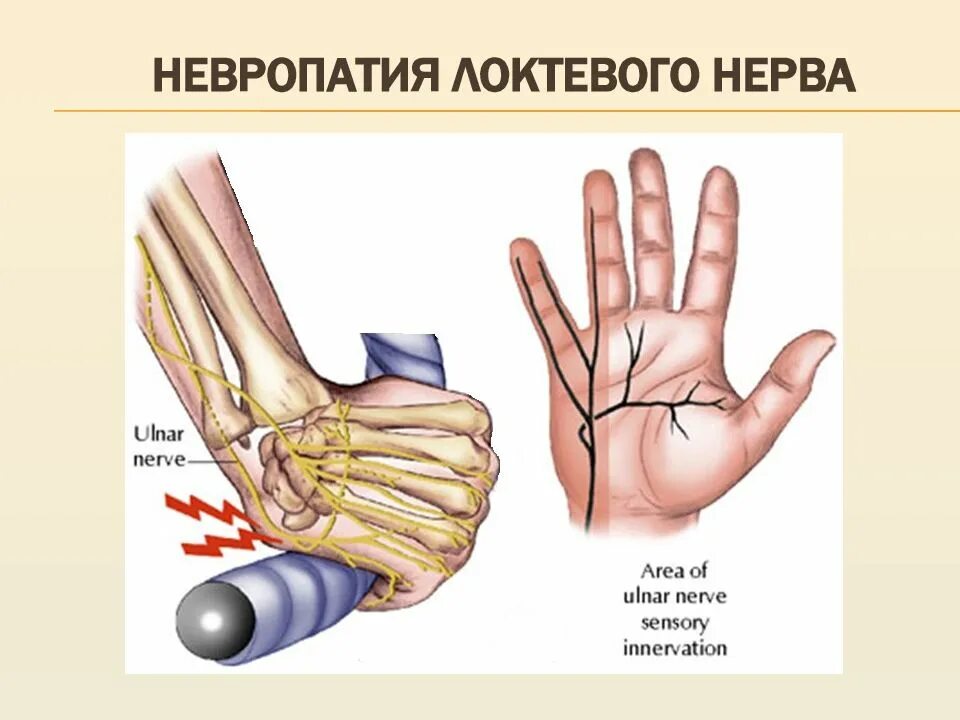 Неврит (невропатия) локтевого нерва.. Невропатия локтевого нерва симптомы. Нейропатия локтевого и лучевого нерва. Нейропатия локтевого нерва синдром.