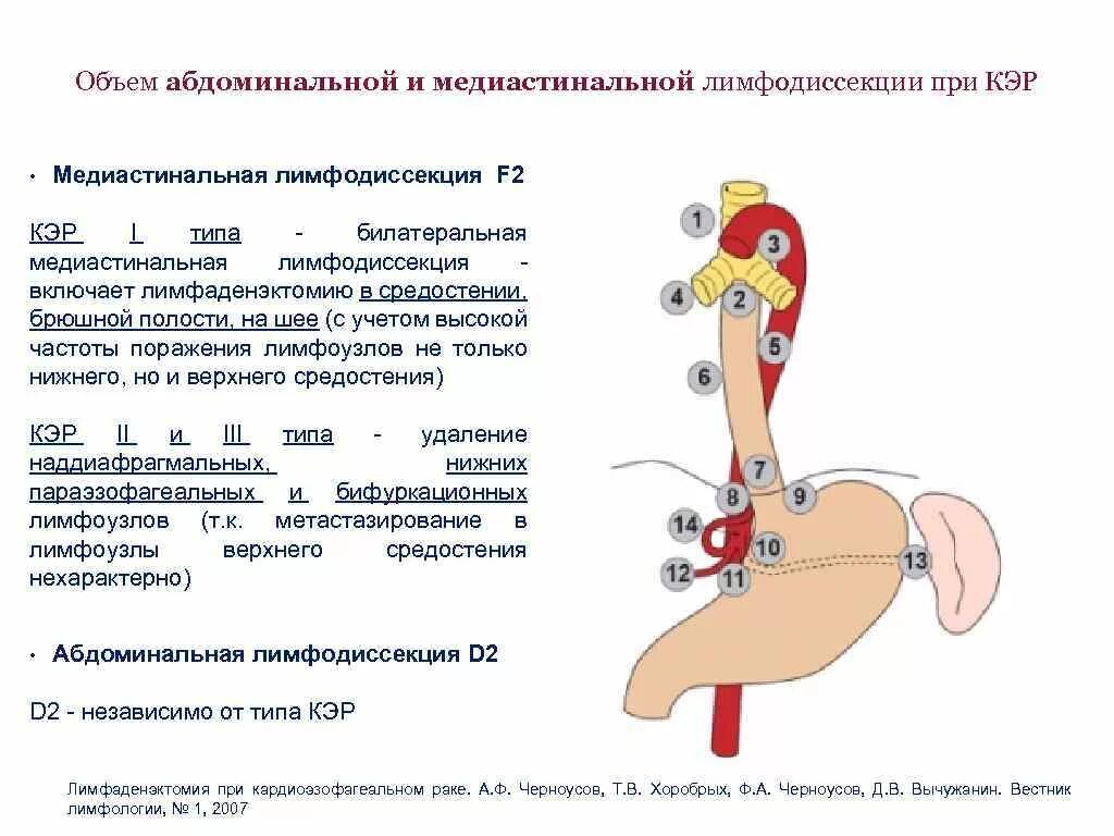 Лимфаденэктомия это. Медиастинальная лимфодиссекция. Медиастинальная лимфомэктомия. Расширенная медиастинальная лимфодиссекция. Операция Центральная лимфодиссекция.