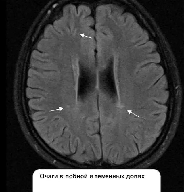 Демиелинизация головного. Демиелинизация головного мозга мрт. Демиелинизация лобных долей. Белое вещество лобных долей очаги. Очаг в лобной доли.