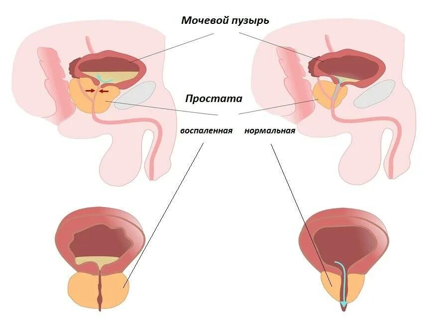Простата хочет. Простатит предстательной железы. Заболевания предстательной железы. Патология предстательной железы.
