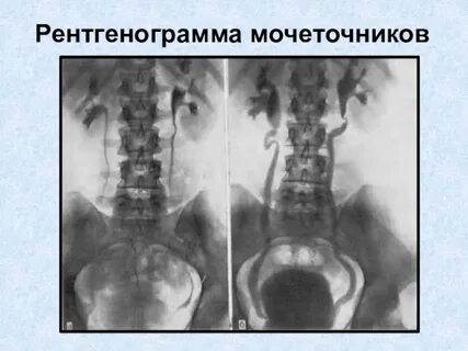Заброс мочи в почки