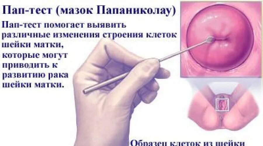 Можно Ли Заниматься Сексом Перед Цитологией