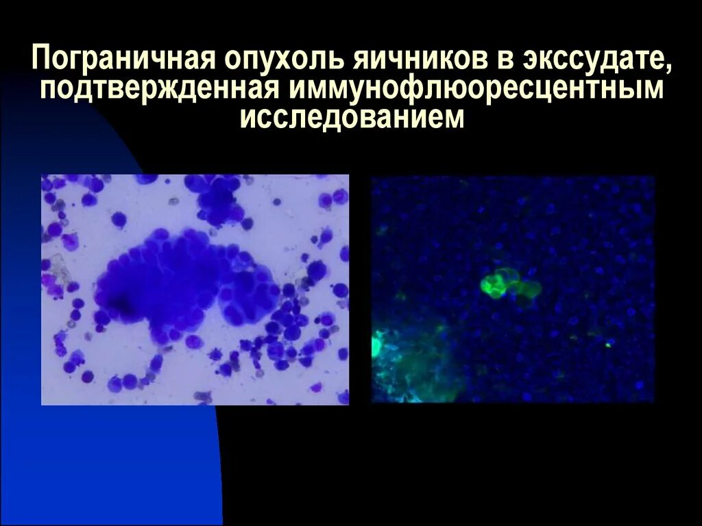 Муцинозная Пограничная опухоль яичника. Пограничная опухоль яичника гистология. Пограничная муцинозная опухоль яичника гистология. Пограничная опухоль яичника цитология. Серозная пограничная опухоль