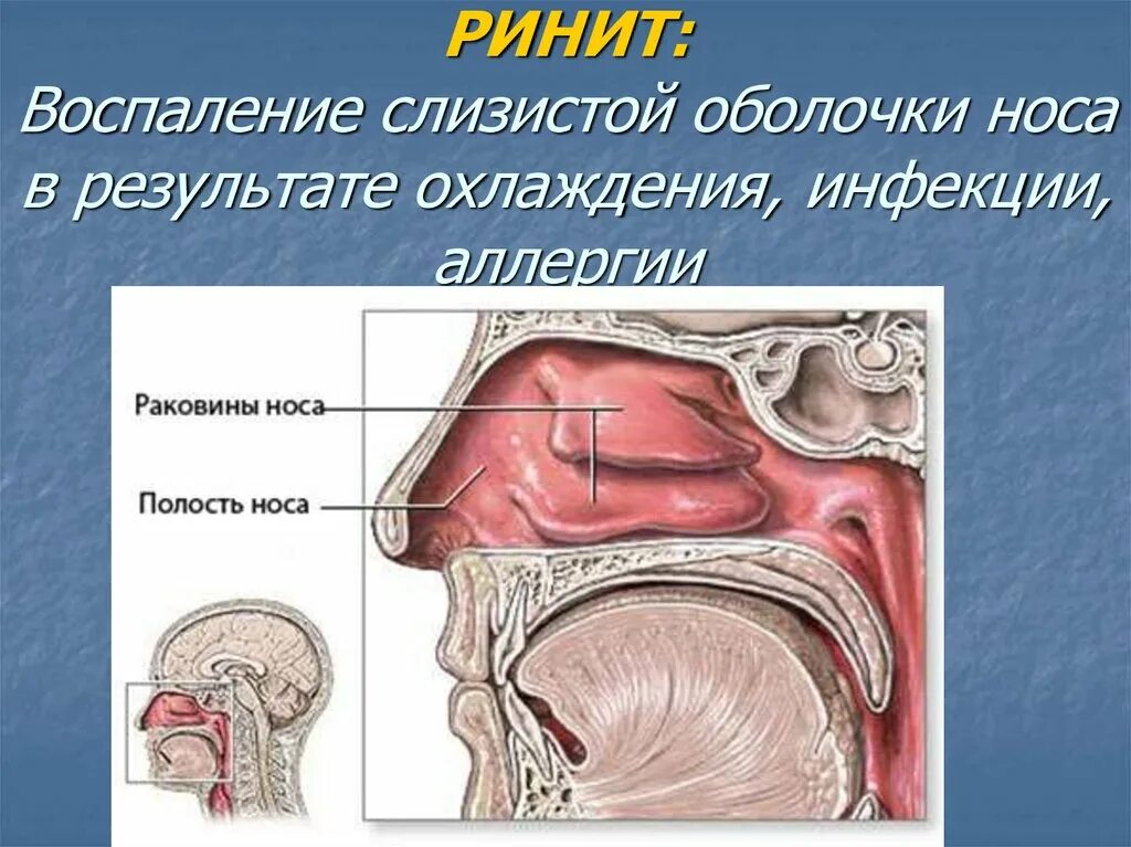 Нос заболевание насморк. Воспаление слизистой оболочки носа. Слизистая оболочка носа. Слизистытые оболочки носа.