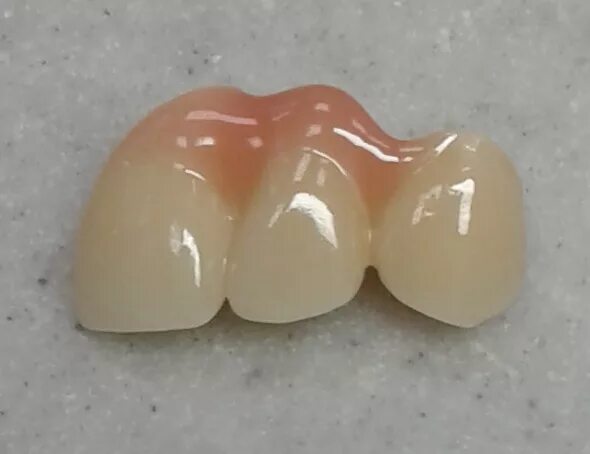 коронка с искусственной десной. оксид циркония безметалловая керамика а1. оксид циркония преттау. десна из циркония. циркониевая балка на 6 имплантах.