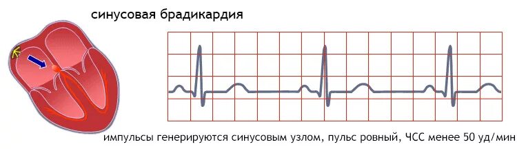 Брадикардия у ребенка 10. Синусовый ритм. брадикардия. синусовая тахикардия и брадикардия. чсс при синусовой брадикардии. аритмия брадикардия.
