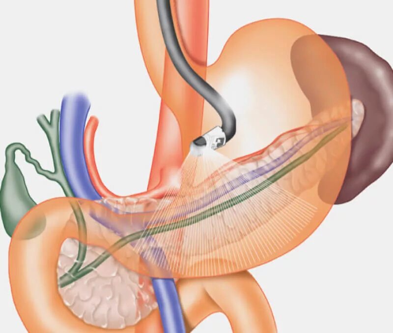 Исследования пищевода и желудка. Двенадцатиперстная кишка ФГДС. Гастроскопия двенадцатиперстной кишки. ФГДС И желудочному зондированию.. Гастроскопия (ФГДС) желудка.