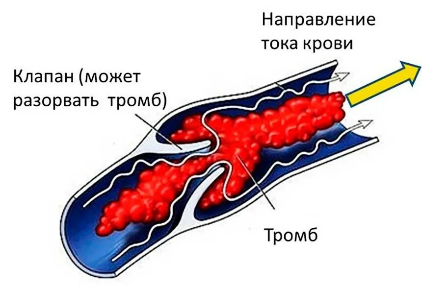 Размеры тромбов. Тромбофлебит периферической вены.