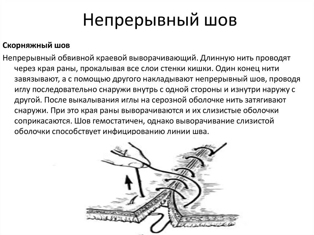 Шов для мужа что это. Непрерывный обвивной шов в хирургии. Непрерывный Скорняжный шов Ветеринария. Простой непрерывный обвивной шов. Скорняжный хирургический шов.