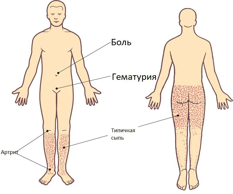 Тромбоцитопеническая пурпура кожные проявления. Петехиальная сыпь и геморрагическая сыпь. Геморрагический васкулит высыпания. Геморрагический васкулит сыпь. Васкулопатия это