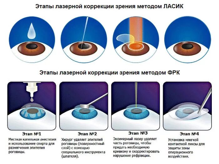 Сколько по времени длится лазерная. Этапы лазерной коррекции зрения ласик. Лазерная коррекция зрения методом Femtolasik. Этапы лазерной коррекции методом LASIK. Этапы лазерной коррекции зрения методом ФРК.