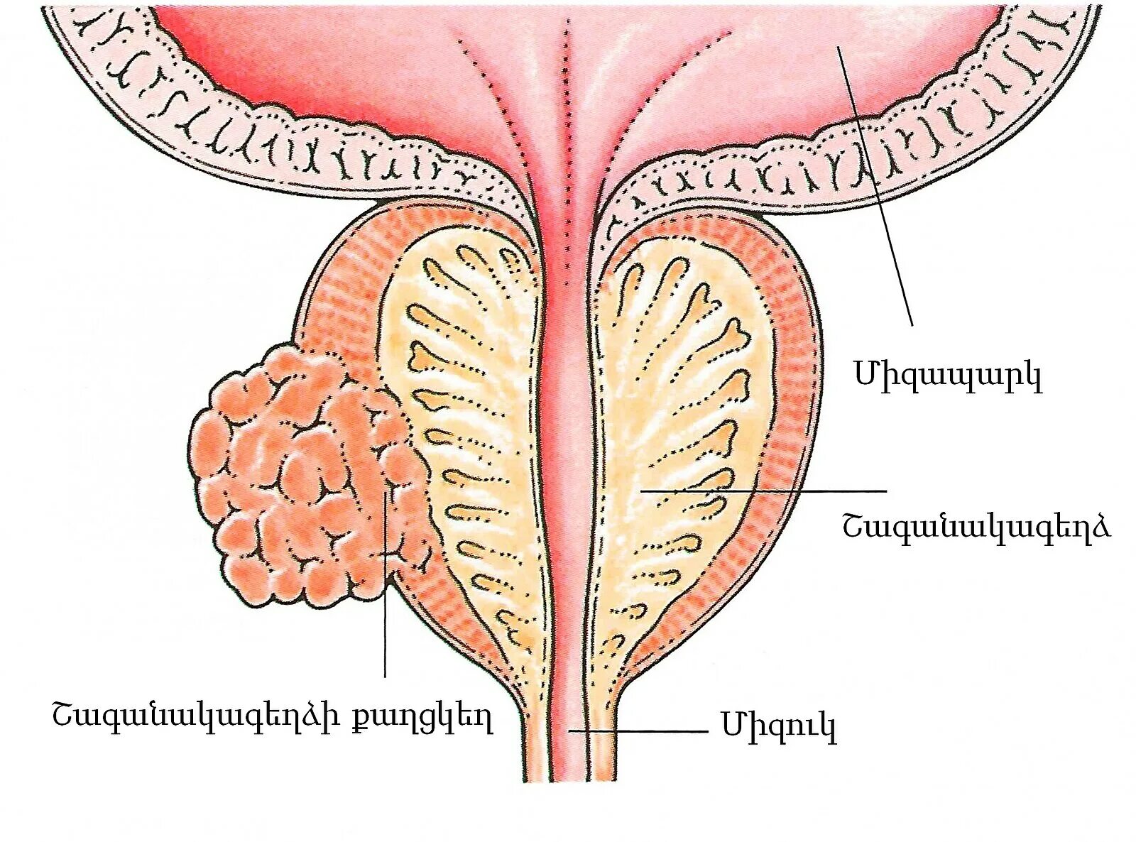 Простата хочет. Анатомия аденомы предстательной железы. Злокачественная аденома предстательной железы. Онкология предстательной железы.