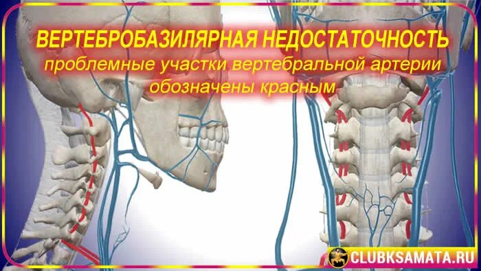 Последствия блокады позвоночника. Блокада позвоночника при остеохондрозе. Блокада при шейном остеохондрозе. Блокада в шею при остеохондрозе. Точки блокады позвоночника.