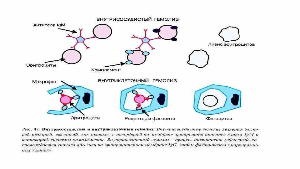 Механизм гемолиза эритроцитов схема. Внутриклеточный гемолиз схема. Внутрисосудистый гемолиз эритроцитов. Гемолиз эритроцитов схема. Иммунный гемолиз