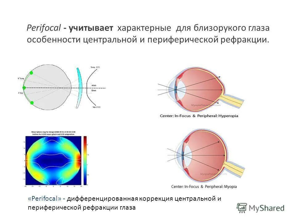 Без перифокальной реакции. Перифокальные линзы для очков. Perifocal строение линзы .. Perifocal линзы для очков. Очки с перифокальными линзами.