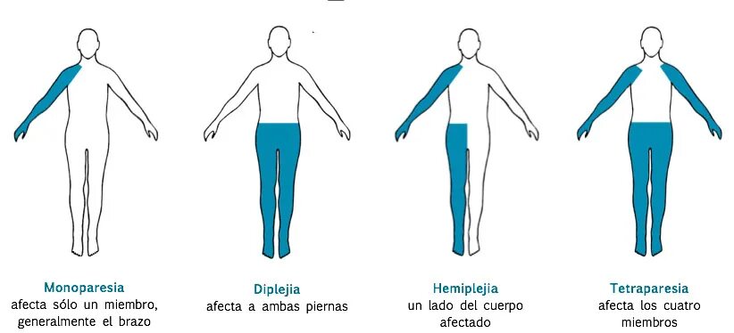 Гемипарез монопарез. Монопарез гемипарез парапарез тетрапарез. Виды парезов конечностей. Гемипарез руки