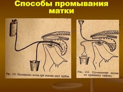 Чистка матки больно