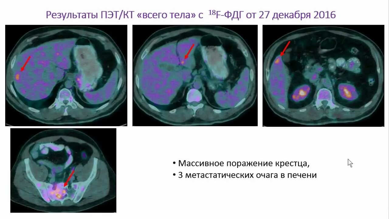 ПЭТ/кт с фтордезоксиглюкозой (18f-ФДГ). ПЭТ С 18f-Dopa. Пэт кт или кт что лучше