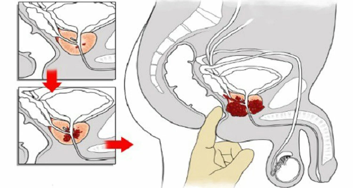 Простата хочет. Массаж предстательной железы. Простата массаж простаты. Схема массажа простаты пальцем.