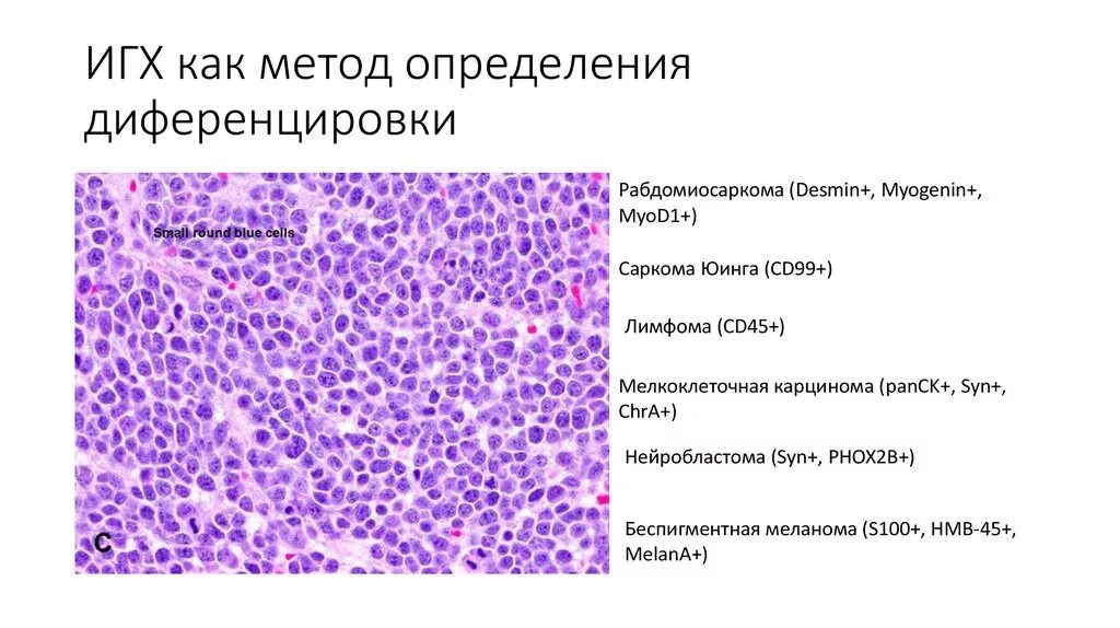 Игх маркеры. Иммуногистохимия метод гистология. Крупноклеточная лимфома гистология. Иммуногистологическое исследование опухоли молочной железы. Исследование ИГХ опухоли молочной железы.