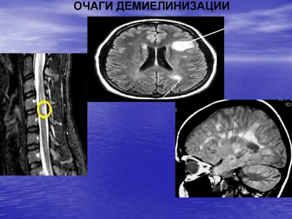 Демиелинизирующие заболевания головного мозга на мрт. Демиелинизация зрительного нерва на мрт. Демиелинизирующее заболевание ЦНС на мрт. Очаги демиелинизации головного мозга на мрт.