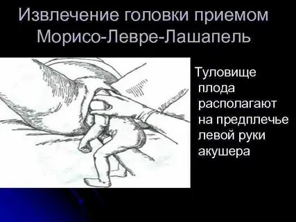 Прием морисо левре лашапель