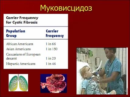 Муковисцидоз люди