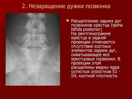Незаращение с1